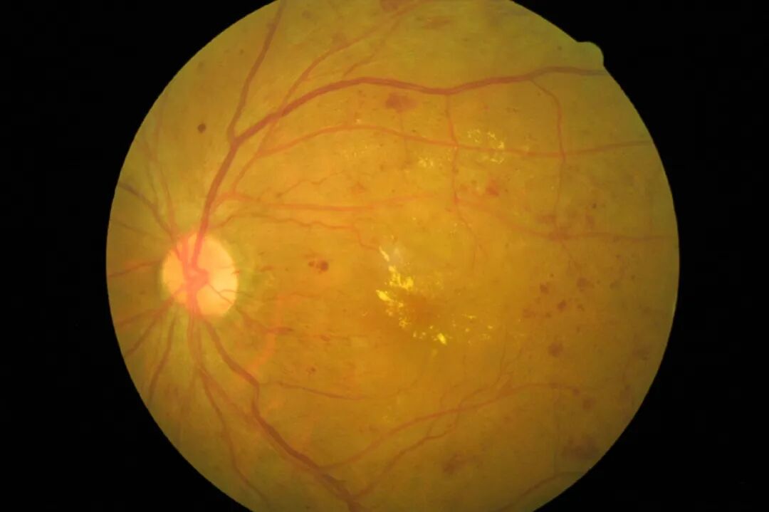 6种常见眼病,看看你有没有这些症状? - 广州普瑞眼科医院