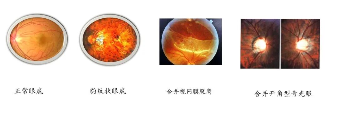 如何有效防控近视? - 广州普瑞眼科医院