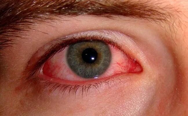 6种常见眼病,看看你有没有这些症状? - 广州普瑞眼科医院