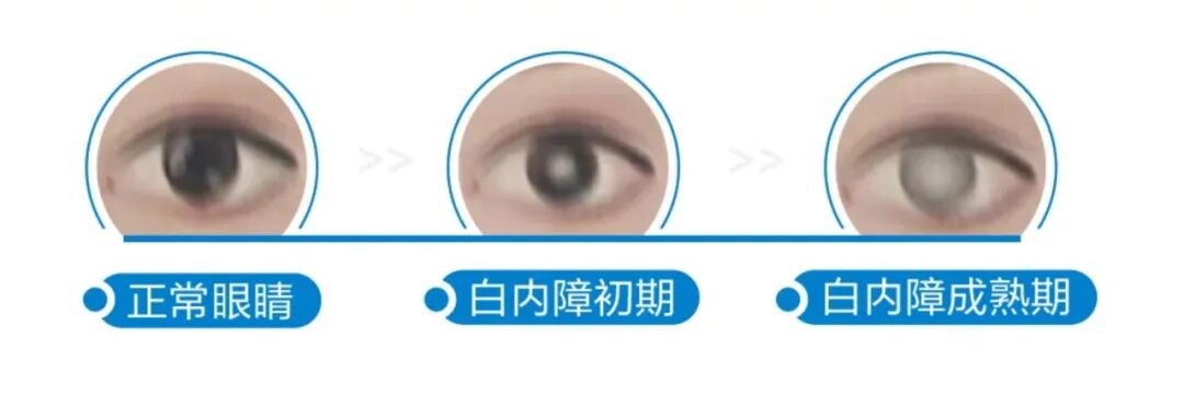 【白内障专科】广州医科大学附属第二医院沙翔垠教授、广州市第一人民医院眼科原主任杨为中教授、广东省人民医院费文雷教授 - 广州普瑞眼科医院
