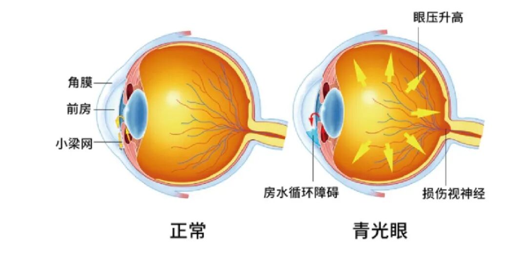 【青光眼专科】广东省人民医院眼科原主任费文雷教授 - 广州普瑞眼科医院